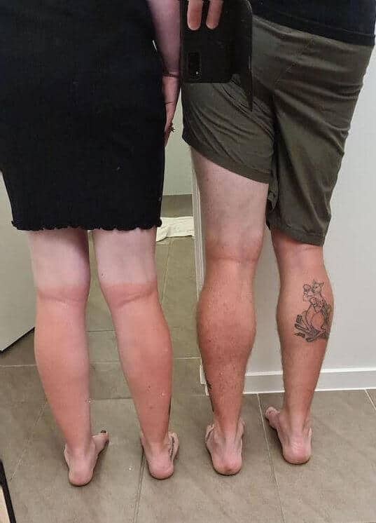 sunburnt legs after snorkelling